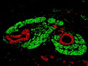 Pancreatic cancer forms "synapses"